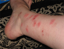 bed bug bites leg