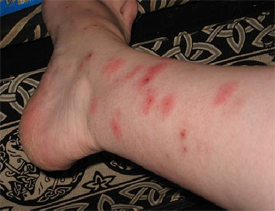 bed-bug-bites-leg bed bug bites leg